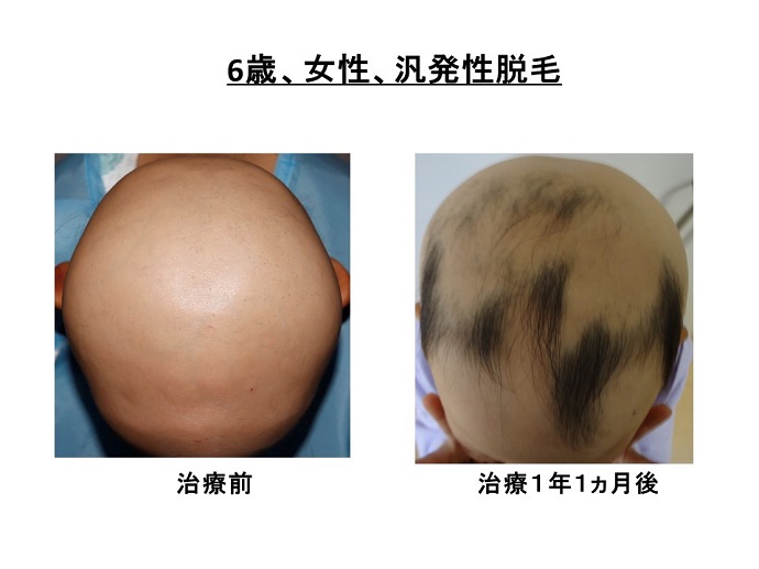 円形脱毛症　病院